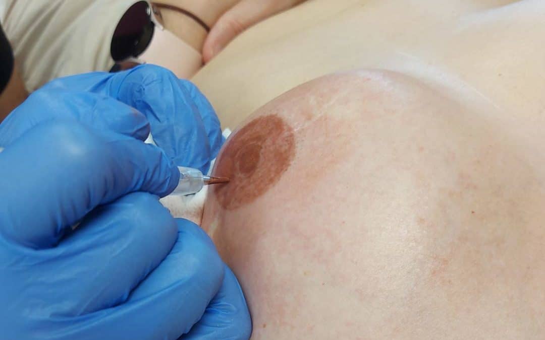 Qu’est-ce que la dermopigmentation réparatrice ?
